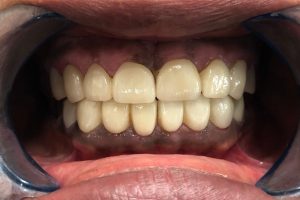 POST OP FULL MOUTH REHABILITATION 2